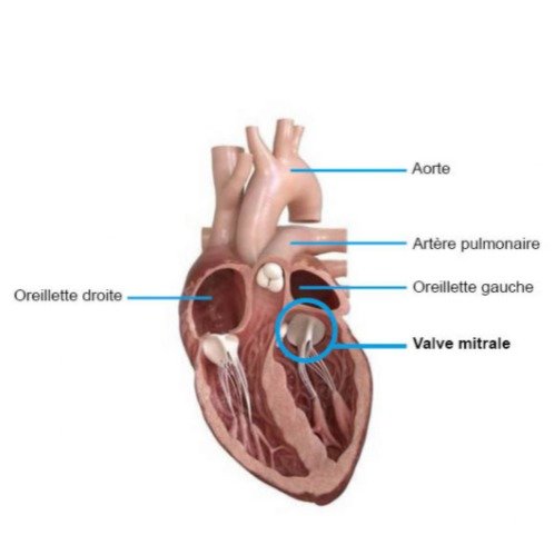 La numérisation au service d’un nouvel implant cardiaque